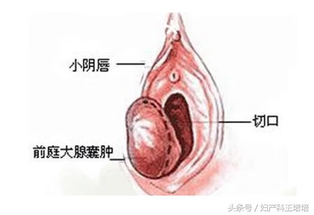 前庭大腺囊肿在哪个位置(前庭大腺囊肿和性有关吗)