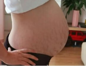 妊娠纹淡化过程(妊娠纹可以淡化到什么程度)