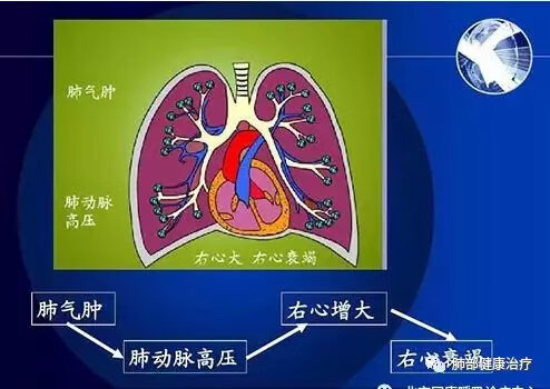咳嗽气喘是什么原因(经常咳嗽气喘是怎么回事)