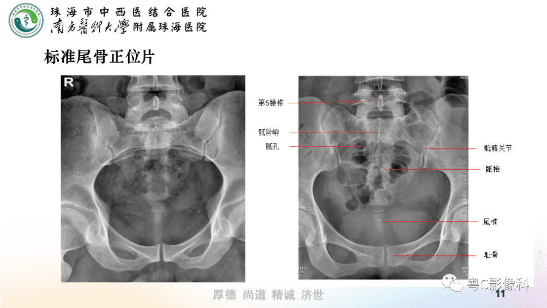 后侧位体视频(后侧体位展示)