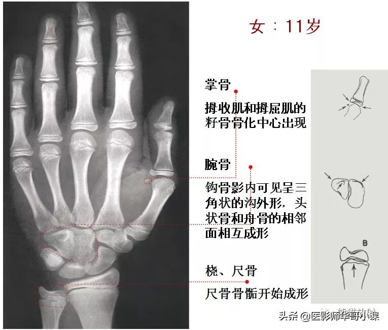 怎样测骨龄?(测骨龄的最佳年龄)