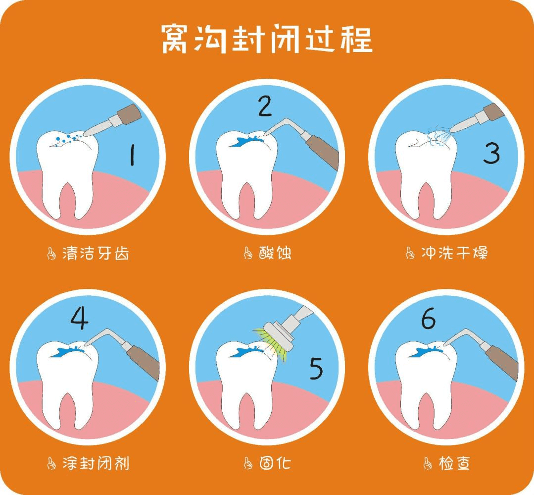 牙齿窝沟封闭是什么(窝沟封闭对牙齿有害吗)