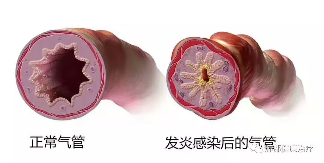 咳嗽气喘是什么原因(经常咳嗽气喘是怎么回事)