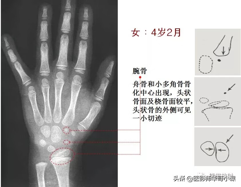 怎样测骨龄?(测骨龄的最佳年龄)