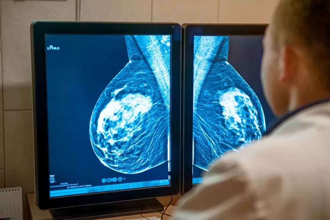 乳腺癌的中期症状照片图片