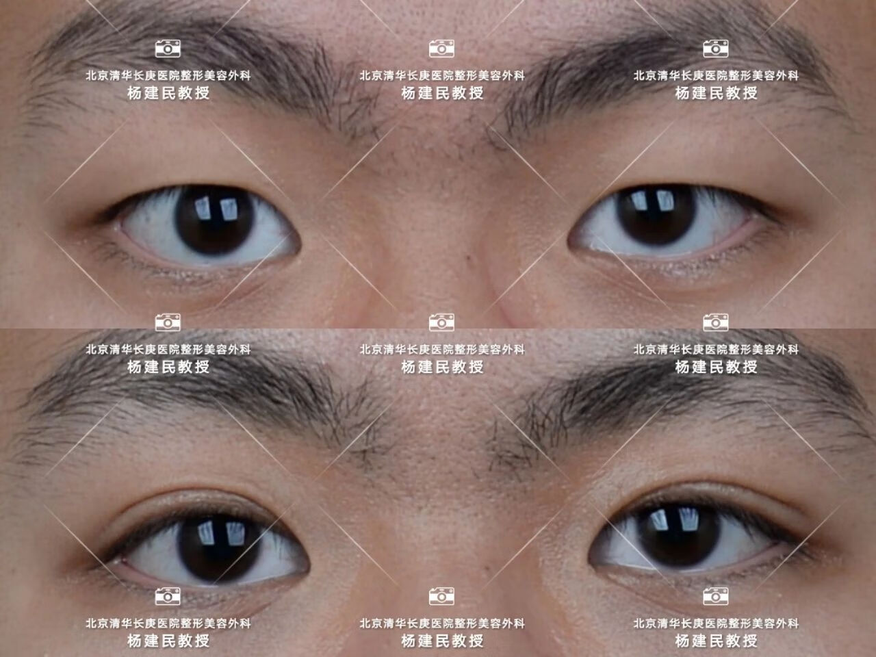 割双眼皮埋线法(双眼皮埋线图片)
