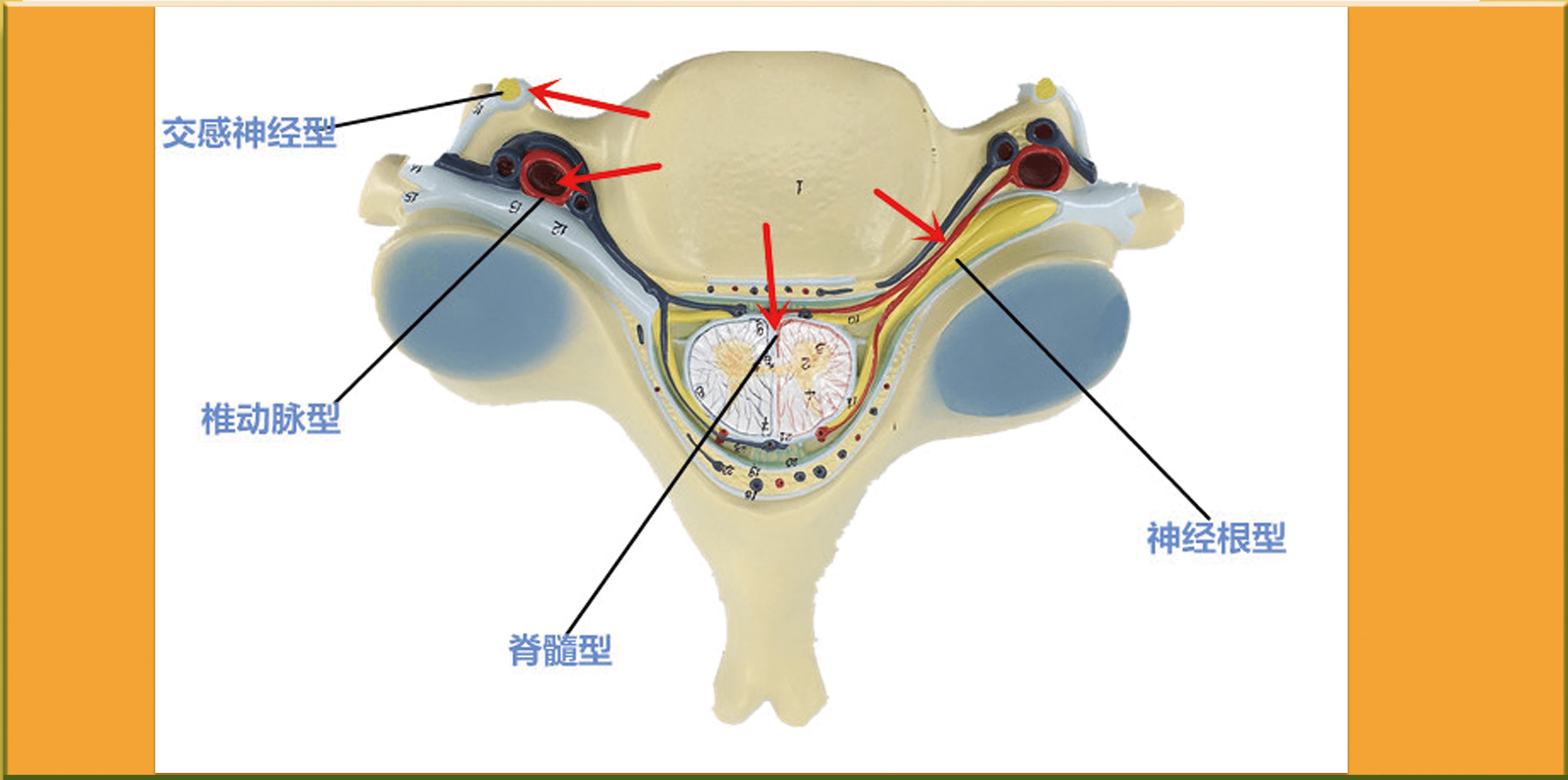 頸椎病分為:神經根型,脊髓型,交感神經型,椎動脈型,其他類型(食管型