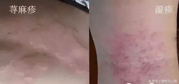 皮炎湿疹荨麻疹(过敏性湿疹图片)