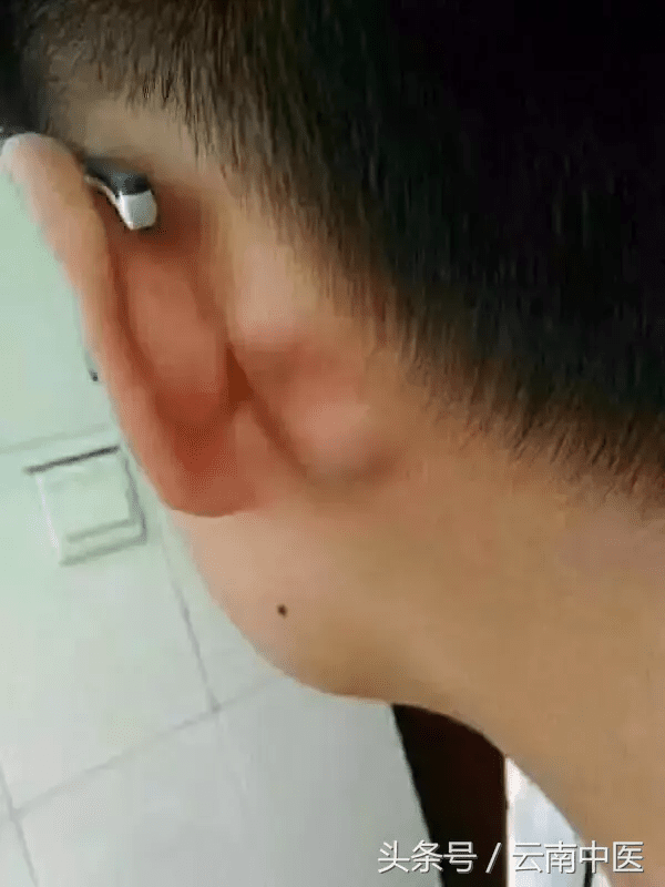 耳朵后面长包是什么原因(耳朵里面长了一个包)