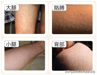 鸡皮肤用什么药最有效(鸡皮肤擦什么药好)