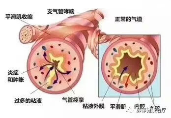 咳嗽气喘是什么原因(经常咳嗽气喘是怎么回事)