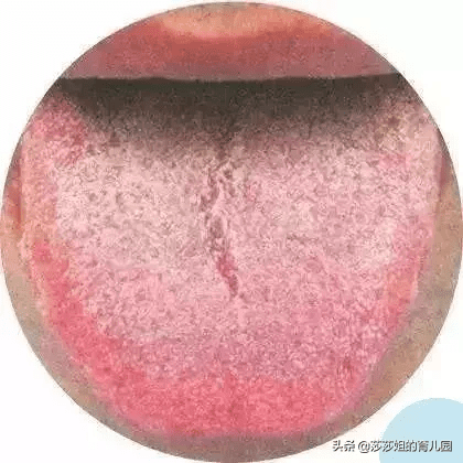 舌头发黄开裂是怎么回事(舌头表面发黄是怎么回事)
