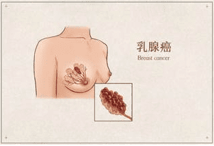 乳房涨痛疼是什么原因(月经前10-15天乳房胀痛)