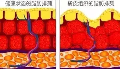 橙皮纹是什么(橘皮纹是什么意思)