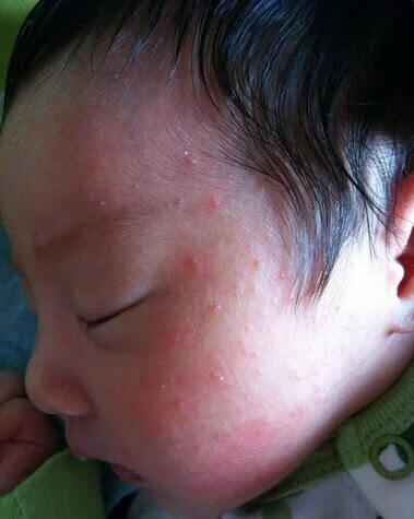 婴儿湿疹的症状起因(婴儿湿疹是什么症状)