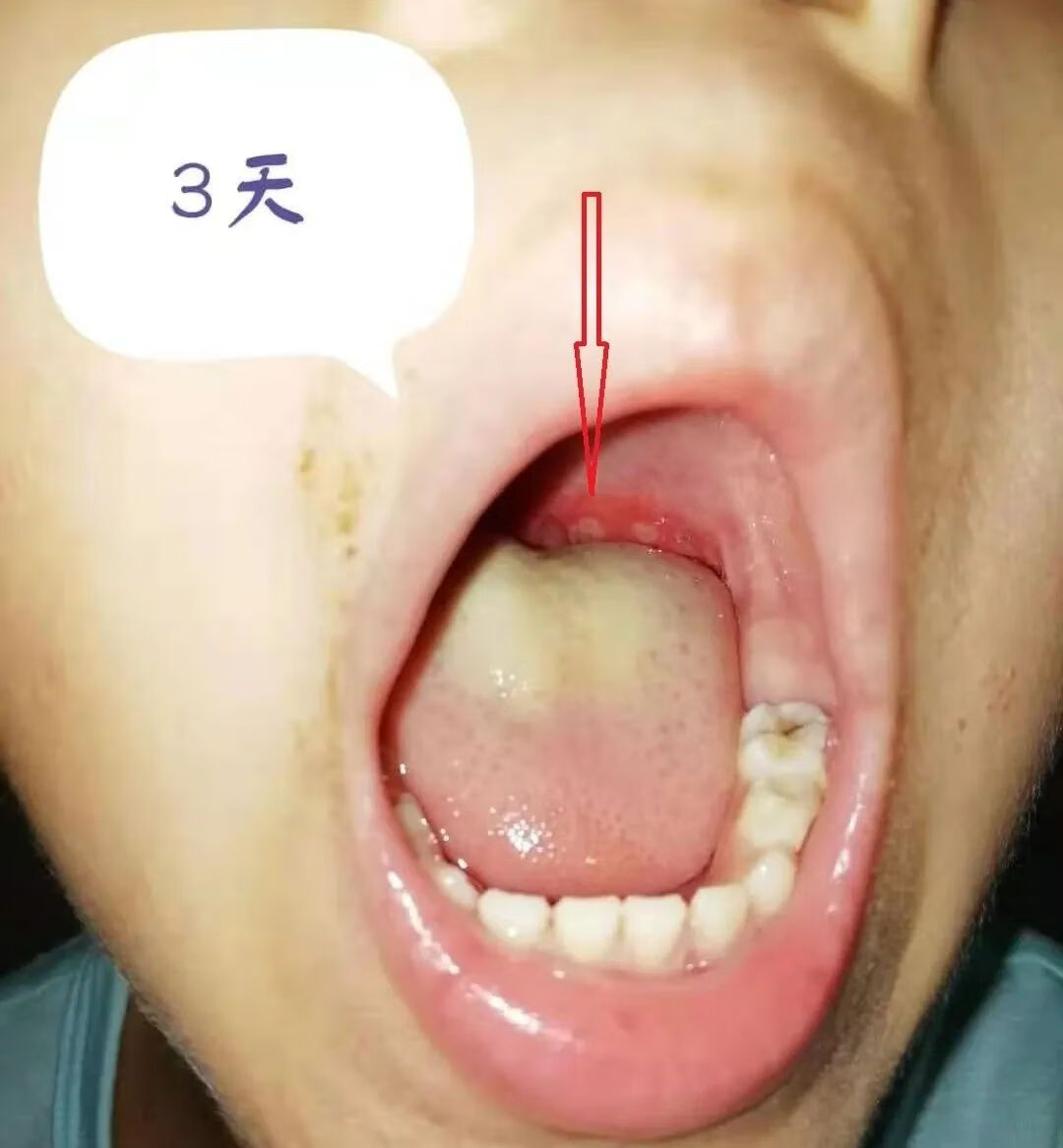 疱疹性口腔炎图片(成人为什么会得口腔疱疹病毒)