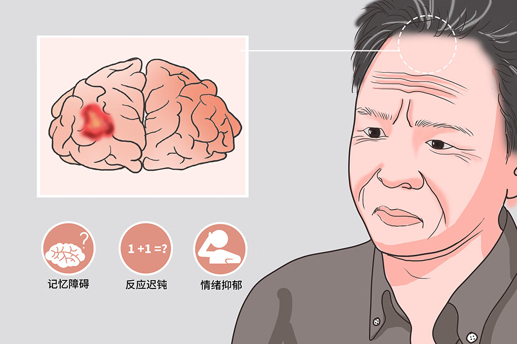 多系统萎缩症是什么病(多系统萎缩的病因)