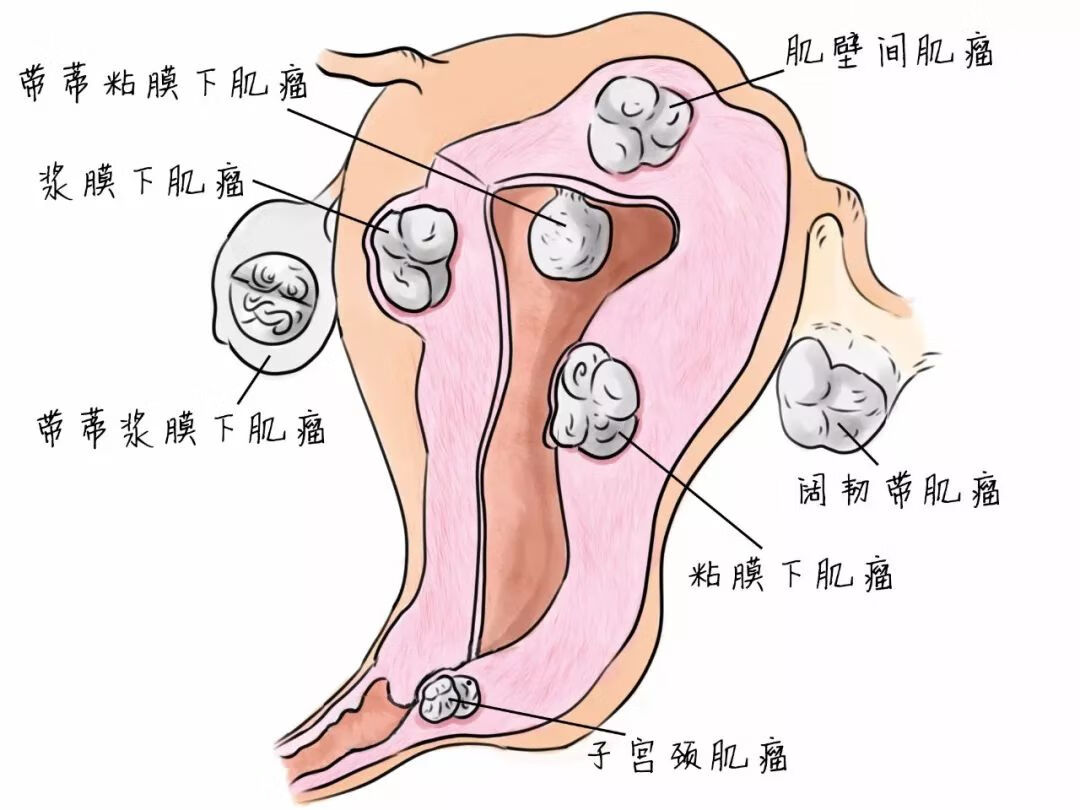 微創子宮肌瘤手術費用(子宮肌瘤做手術費用)