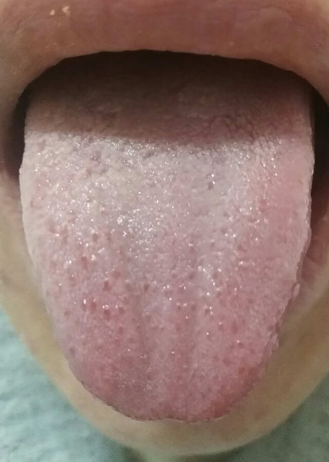 发烧舌头白苔厚是什么原因(舌头右边白苔厚是什么原因)