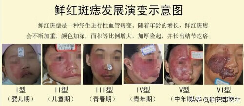 胎记的价格?(胎记多少钱)