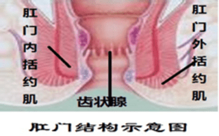 肛瘘是什么症状表现(肛瘘是什么症状表现图片)