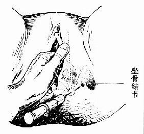 会阴侧切术(阴式手术)
