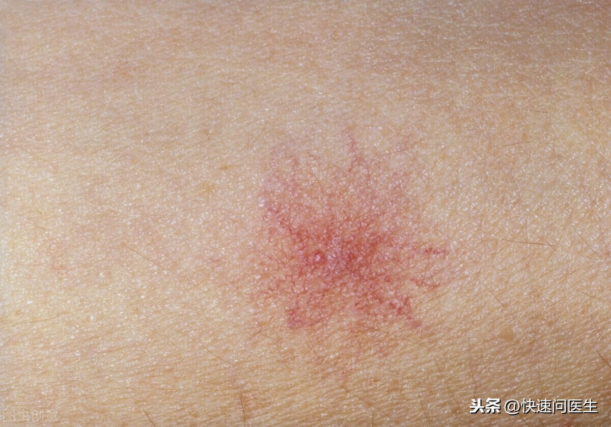 手臂上有小红点点(胳膊上有红色的小点点)