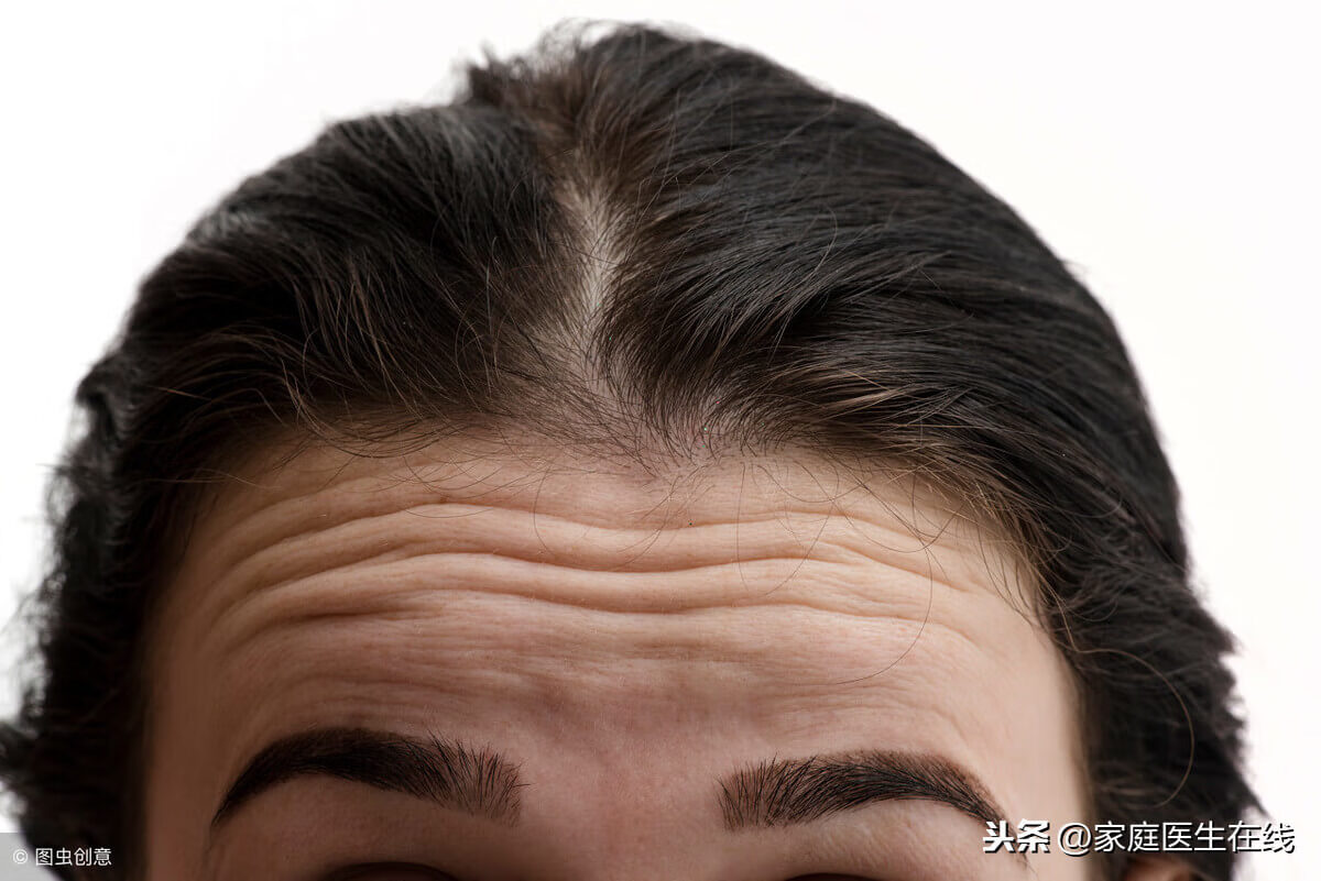 抬头纹比较重怎么办(如何减少抬头纹的方法有哪些)