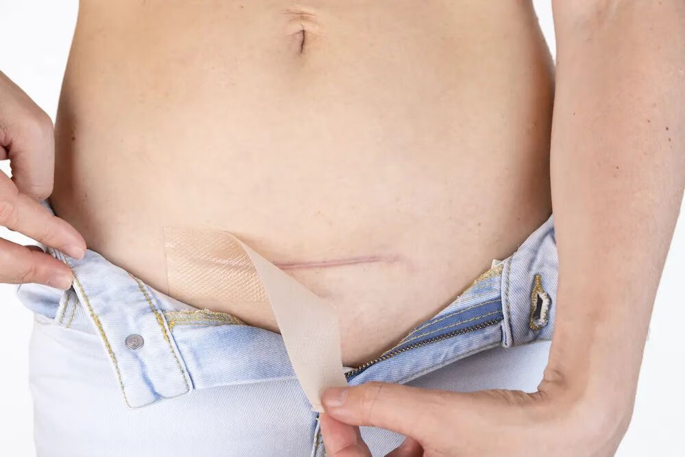 剖腹产的疤痕是什么样子的(剖腹产肚子疤痕)