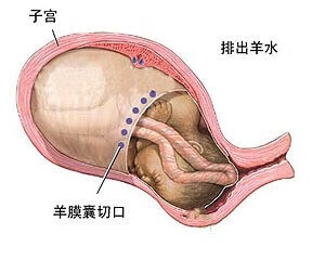 剖宫产手术步骤(剖宫产手术消毒步骤)