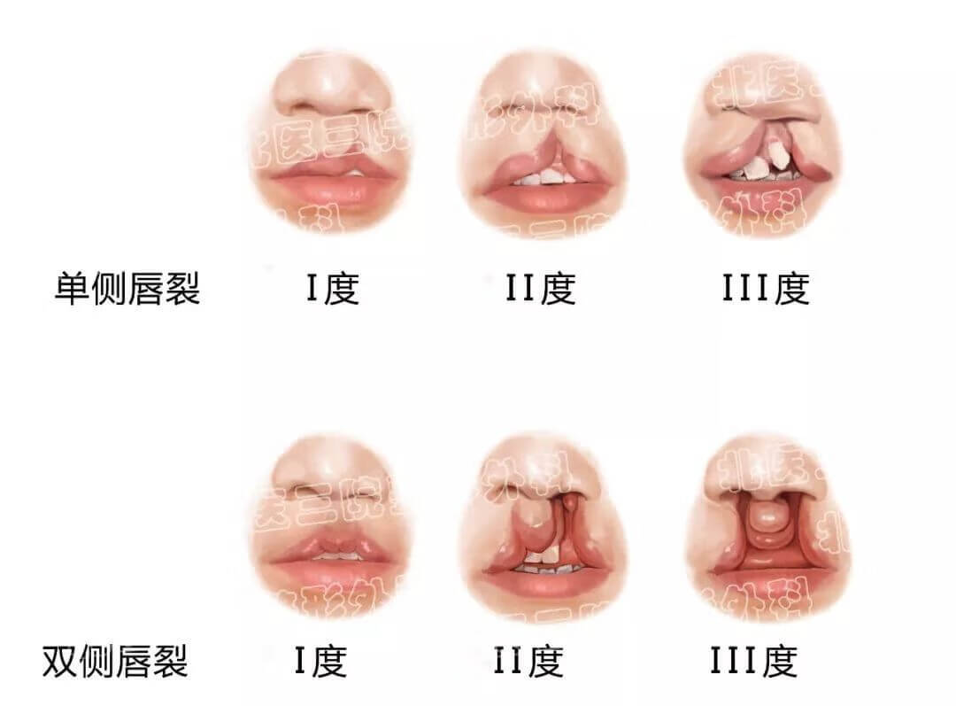 腭裂可以治好吗(腭裂可以治愈吗)