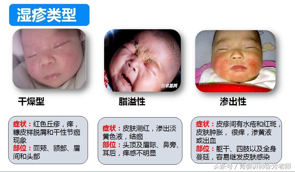 宝宝湿疹图片(小儿干性湿疹)