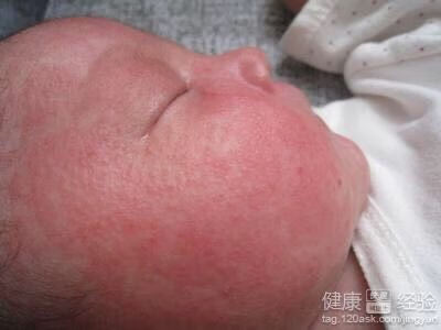 刚出生的婴儿长痱子怎么办(婴儿头上长痱子怎么办)