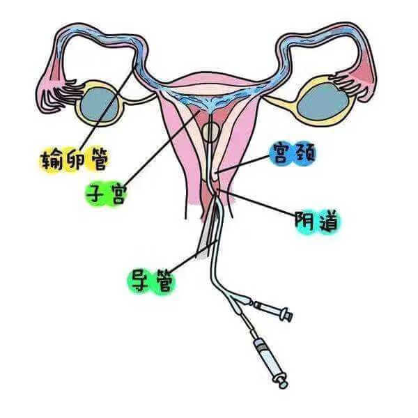 输卵管粘连怎么检查出来(输卵管粘连怎么引起的)