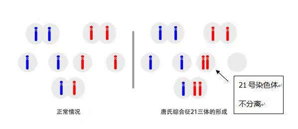 小儿唐氏综合征怎么引起的(小儿唐氏综合征特点)