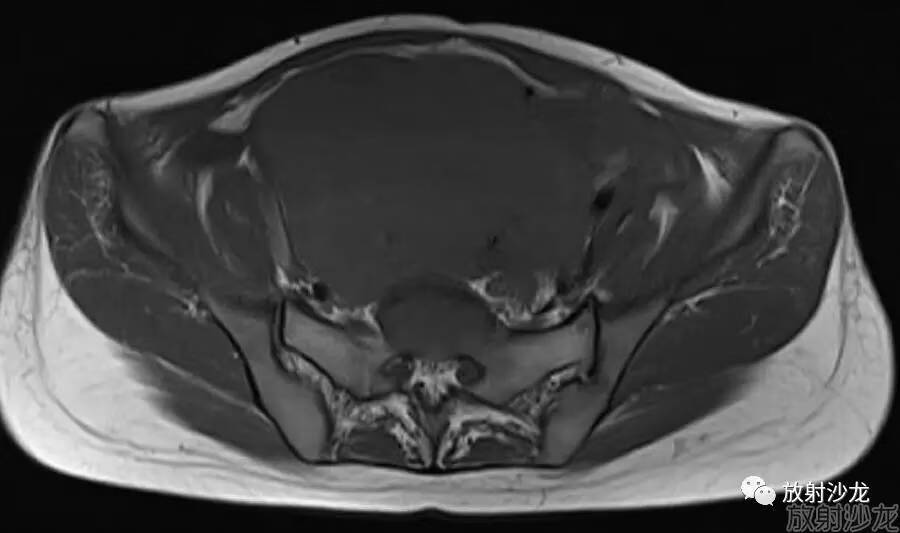 阴囊软纤维瘤图片(外阴瘤)