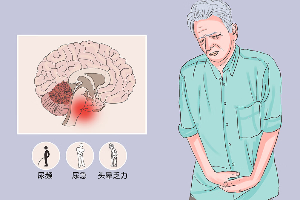 多系统萎缩症是什么病(多系统萎缩的病因)