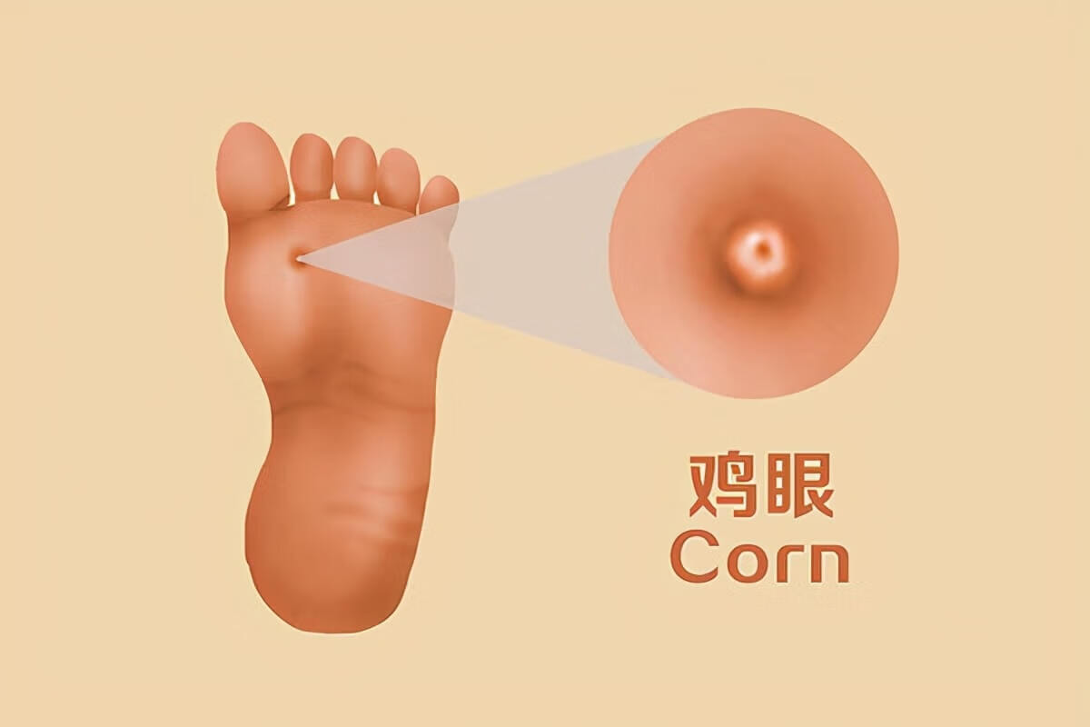 脚上长鸡眼怎么办图片(脚上长了很多鸡眼怎么办)
