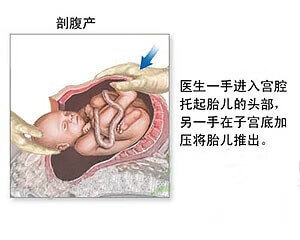 剖宫产手术步骤(剖宫产手术消毒步骤)