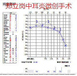 中耳炎费用一般多少(中耳炎治疗费用)