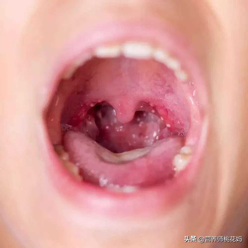 口足手病可以喝奶粉吗(手足口病不能吃什么)