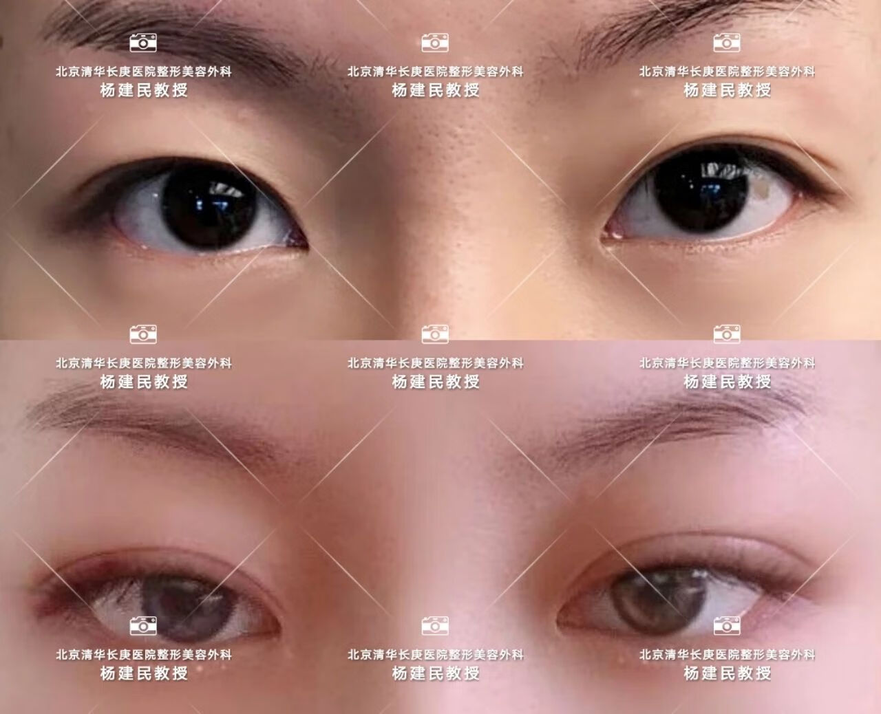 割双眼皮埋线法(双眼皮埋线图片)