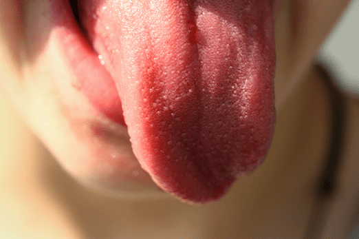 舌苔很白很白是什么原因(舌苔发白喝什么除湿气)