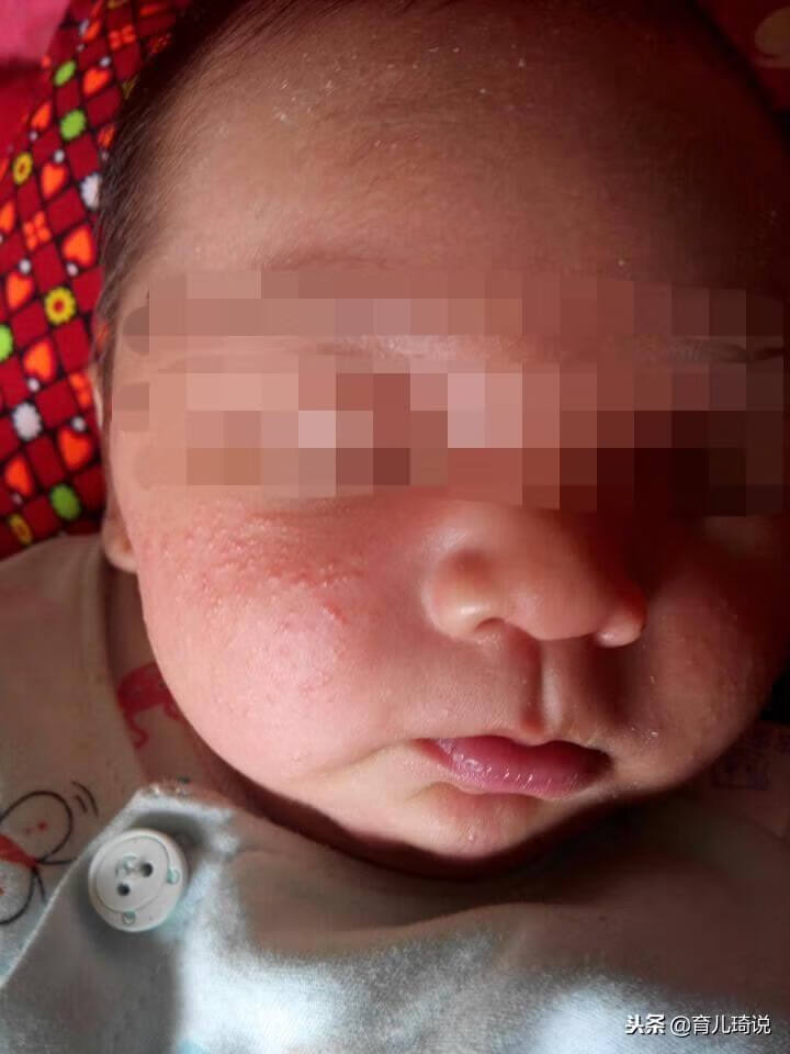 婴儿湿疹图片脸上起湿疹的图片(婴儿皮肤湿疹图片)