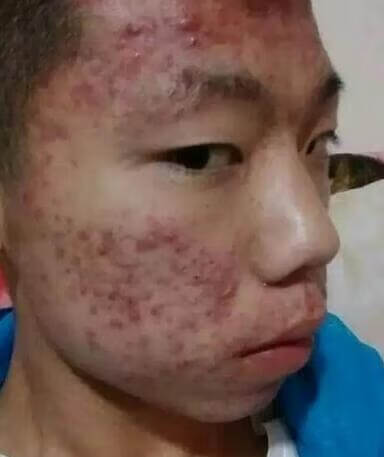 青春期痤疮一般到什么年龄结束(青春期痘痘一般几年)