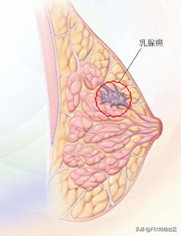 许多乳腺癌患者通过自己发现或常规体检,或乳腺x摄片发现肿块