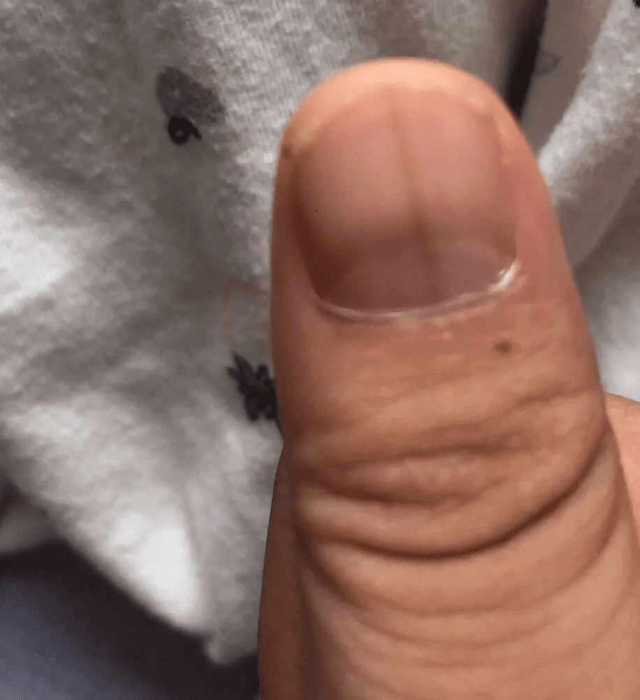 手指甲上有黑色竖纹是怎么回事(手指甲上黑色的竖线)