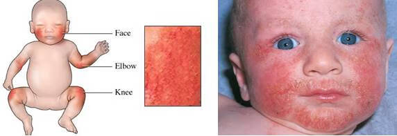 儿童湿疹的症状图片(儿童脸上长湿疹图片)