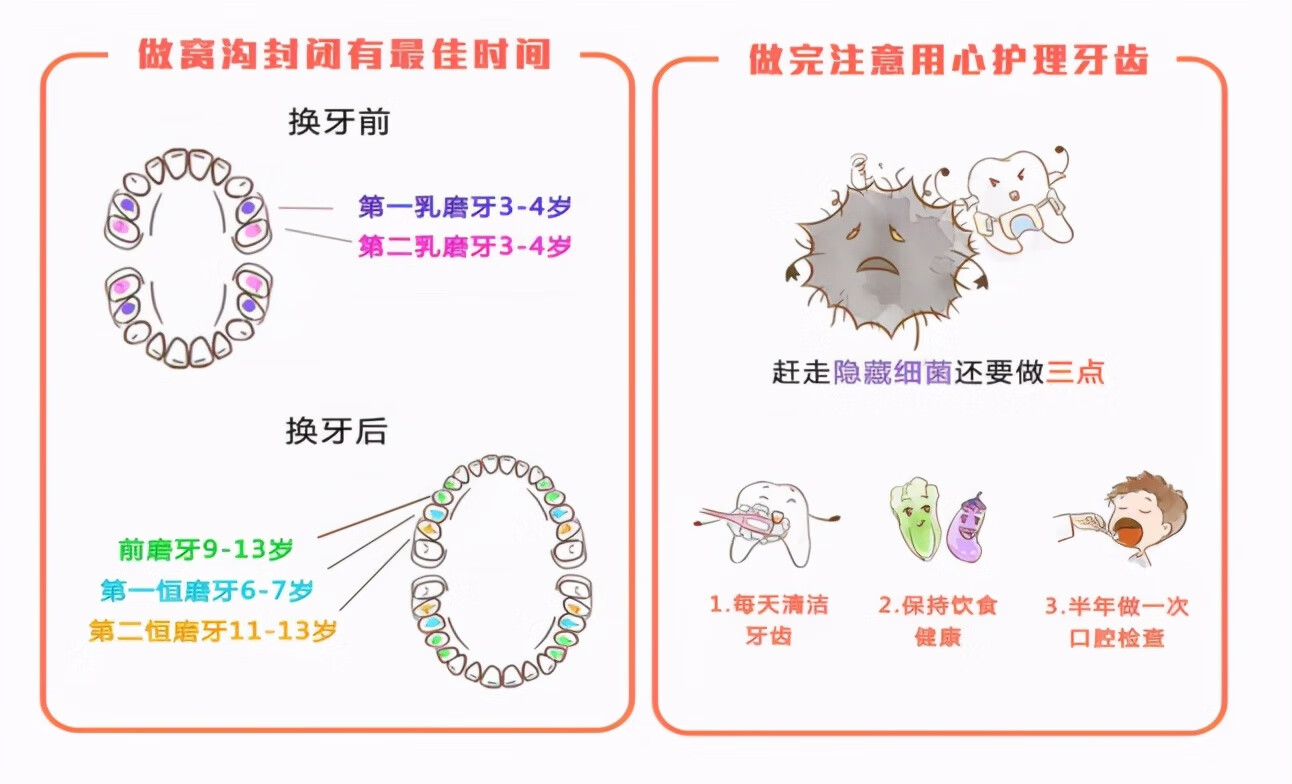 牙齿窝沟封闭是什么(窝沟封闭对牙齿有害吗)