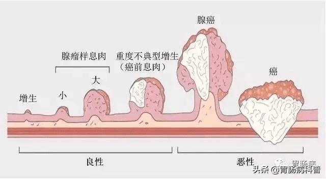 肛门息肉图片(肛门息肉会自己好吗)